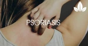 How CBD can help in psoriasis